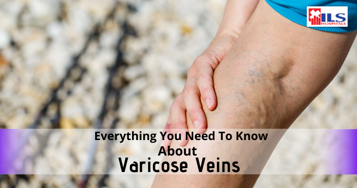 Varicose Veins
