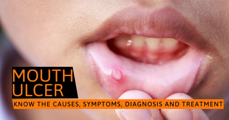 Mouth Ulcer
