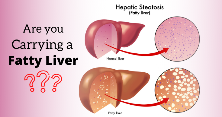 Fatty Liver